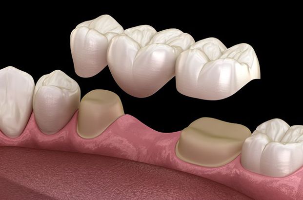 Traditional dental bridge being placed on prepared teeth