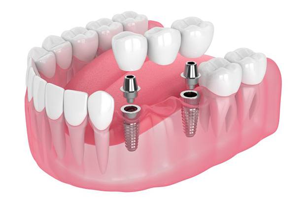 Illustration of dental implant bridge between natural teeth