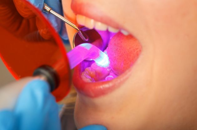 Close up of dental patient having direct bonding on their tooth hardened with curing light