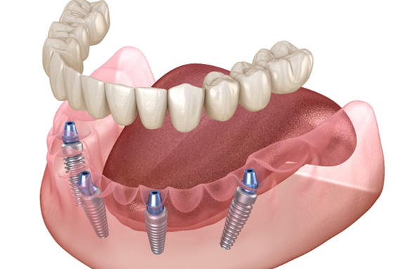 Implant dentures are more expensive but worth the price