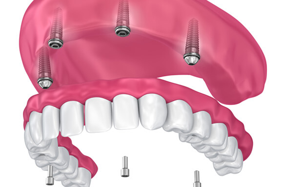 3D render of implant dentures