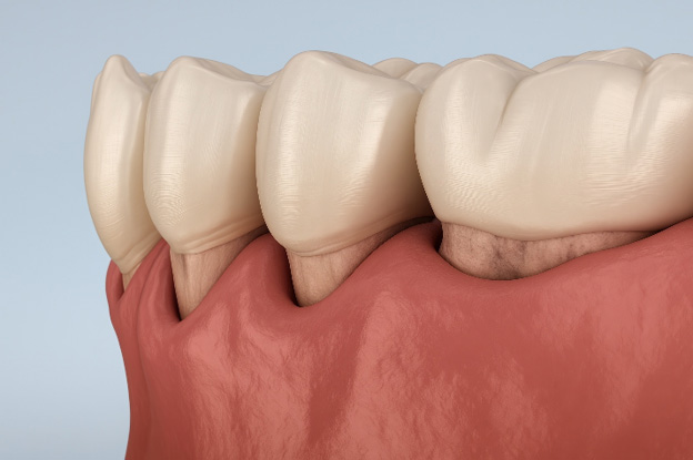 Digital view of gum pockets 