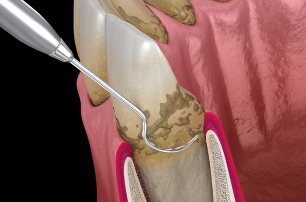 Dentist performing scaling and root planing 