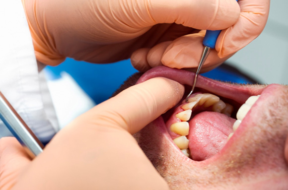 Dentist scaling a patient’s teeth 