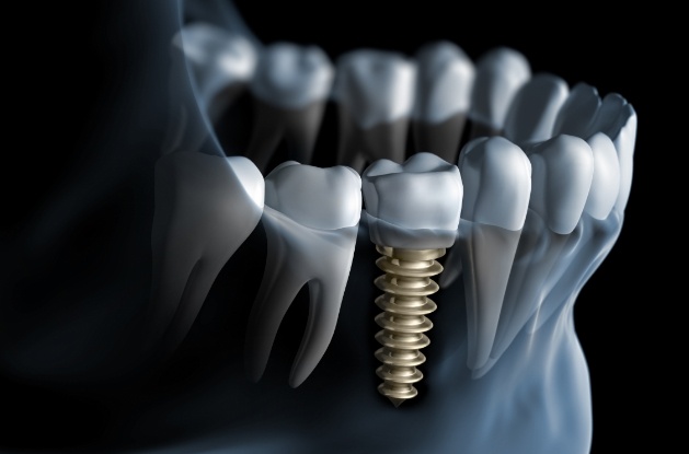 Illustrated X ray of person with dental implant in Westfield replacing one missing tooth