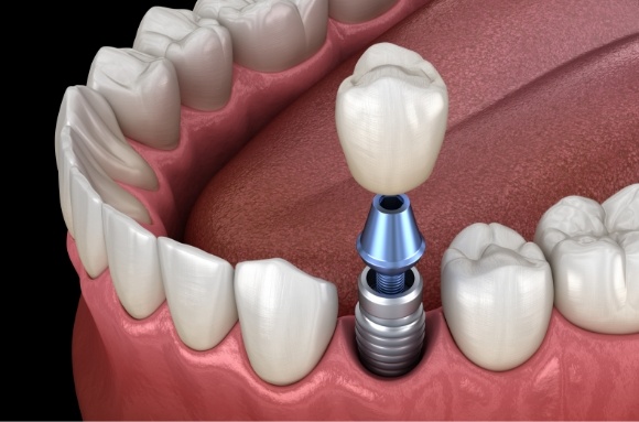 Illustrated dental crown being placed onto a dental implant