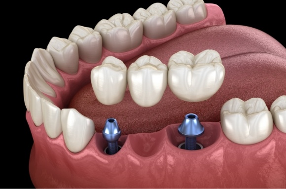 Illustrated dental bridge being placed onto two dental implants