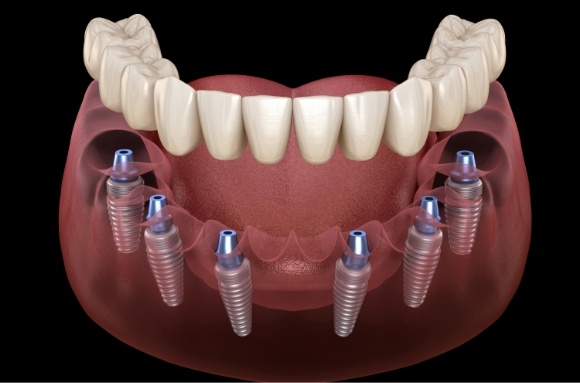 Illustrated full denture being placed onto six dental implants