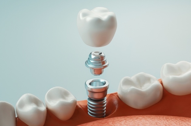 Illustrated dental implant with abutment and crown being placed in lower jaw