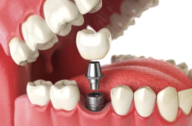 Illustrated model of dental implant being placed in lower jaw