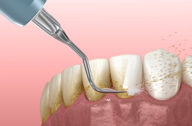 Illustrated dental instrument removing plaque buildup from teeth