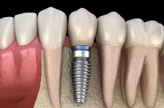 Illustration of dental implant with crown in lower jaw