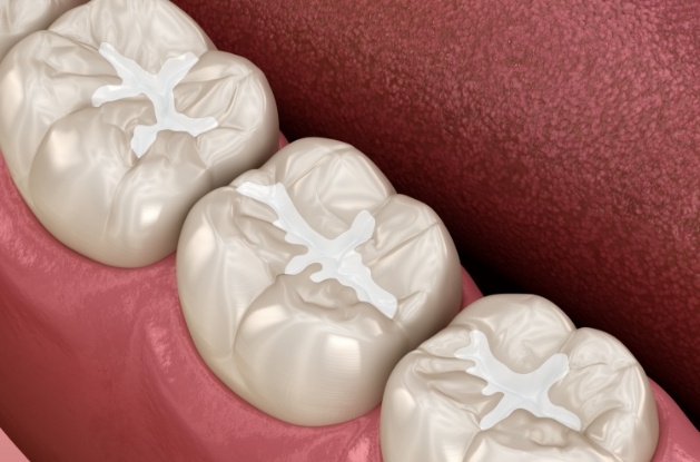 Illustrated row of teeth with barely noticeable tooth colored fillings