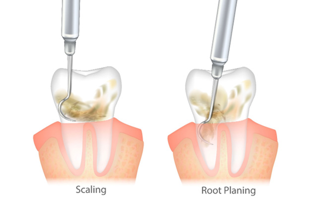 A CGI image depicting the difference between scaling and root planing