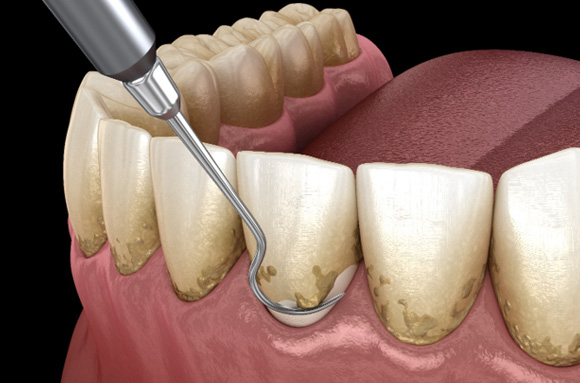 A CGI of teeth that need scaling and root planing