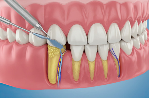 A CGI of a mouth undergoing root planing