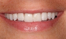 Close up of smile with evenly spaced teeth after treatment from Westfield dentists