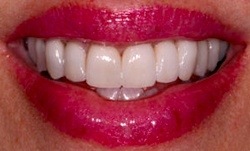 Aligned smile after orthodontic treatment