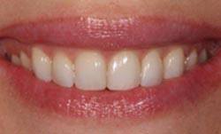 Smile after correcting slightly misshapen teeth