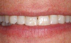 Smile after teeth whitening