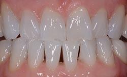 Close up of whiter teeth