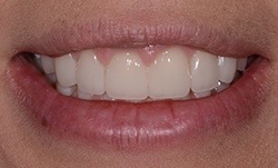Close up of person after gummy smile correction