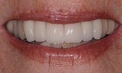 Smile after teeth have been whitened