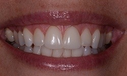Smile with no tooth discoloration