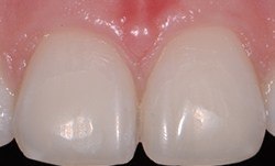 Close up of two teeth after cosmetic dentistry