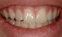 Smile after minor gaps between teeth have been corrected