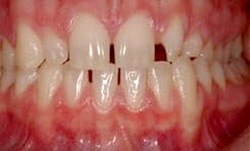 Close up of slight gapped teeth