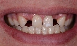 Smile with two missing upper teeth