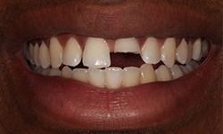 Smile with a severely broken front tooth