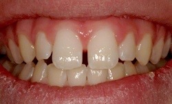 Smile with minor gaps between some teeth