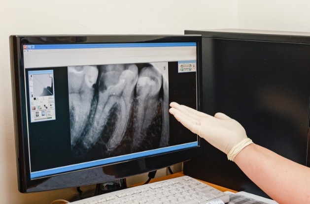 Dentist gesturing to x rays of teeth on computer screen