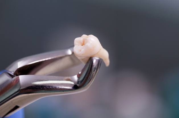 Dental forceps holding a tooth after tooth extractions in Westfield