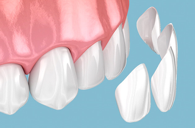 illustration of veneers being placed on top of teeth