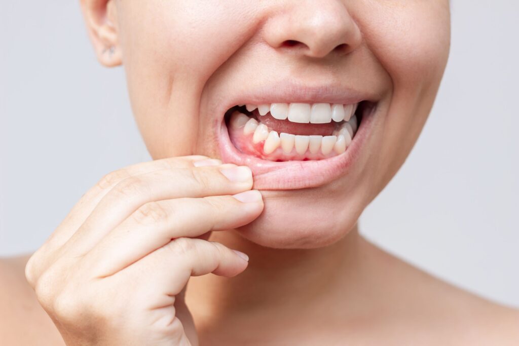 Woman pulling down lip to reveal lump/red gums