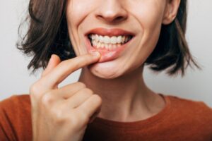 Woman pulling down lip to expose gums.