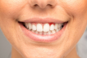 Close-up of smile with inflamed gums