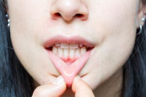 Woman pulling down lip to show receding bottom gums.